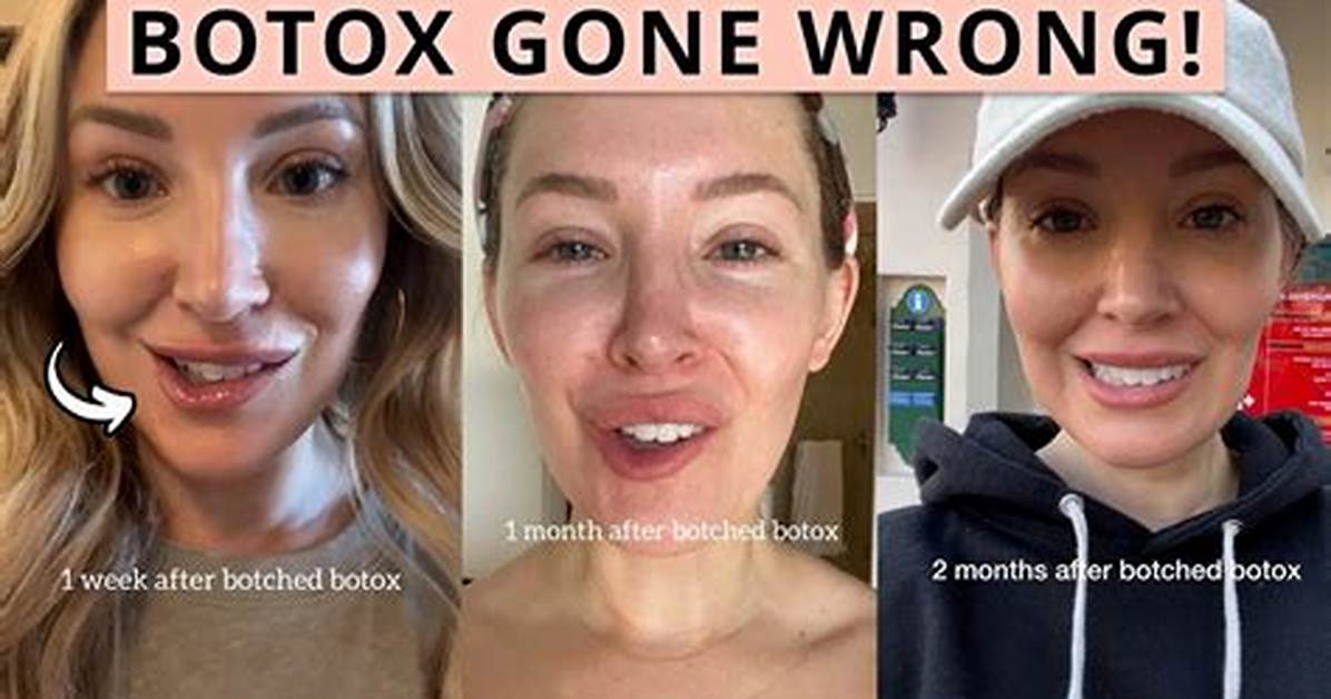 Botox Went Wrong: Understanding the Risks and Consequences